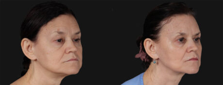 Co2 Laser case #266500