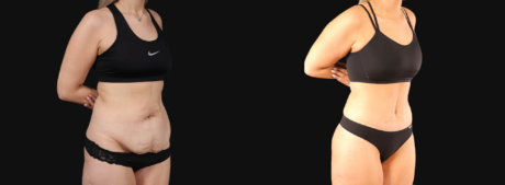 Tummy Tuck case #266607