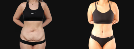 Tummy Tuck case #266607
