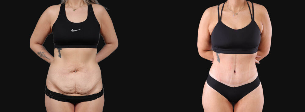 Tummy Tuck case #266607