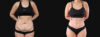 Tummy Tuck case #266607 slider thumbnail
