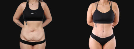 Tummy Tuck case #266607