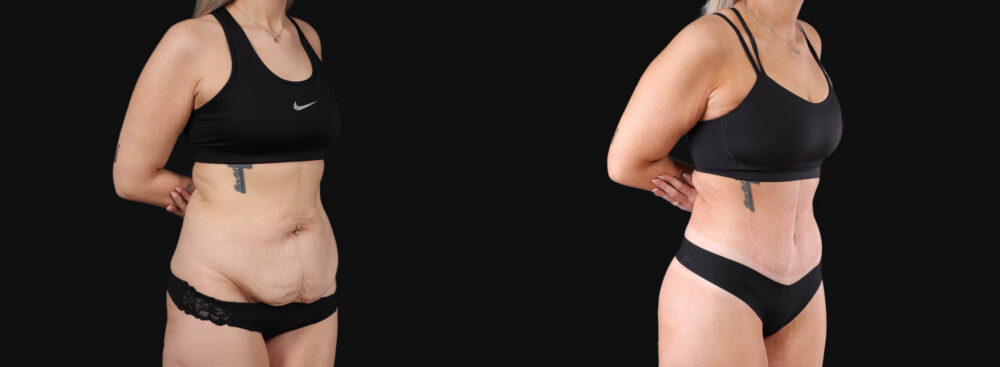 Tummy Tuck case #266607