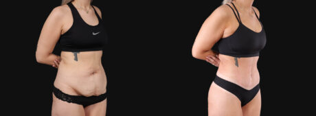 Tummy Tuck case #266607