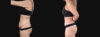 Tummy Tuck case #266607 slider thumbnail