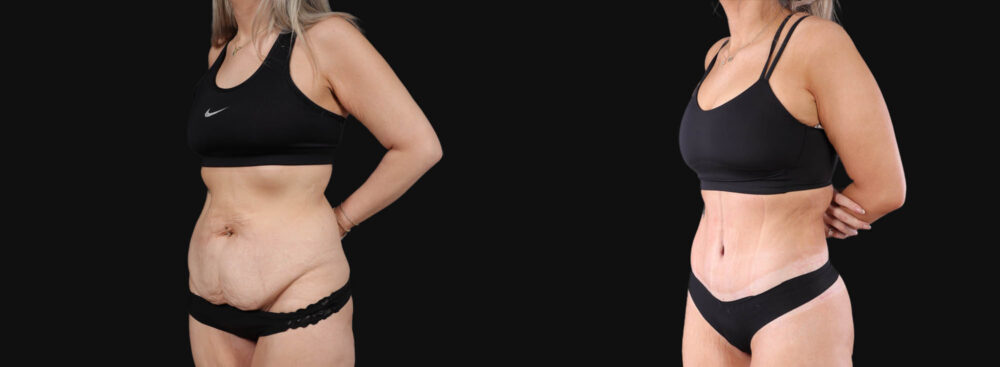 Tummy Tuck case #266607