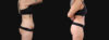 Tummy Tuck case #266607 slider thumbnail