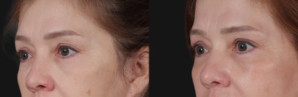 Blepharoplasty case #266684