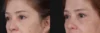 Blepharoplasty case #266684 slider thumbnail