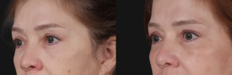 Blepharoplasty case #266684