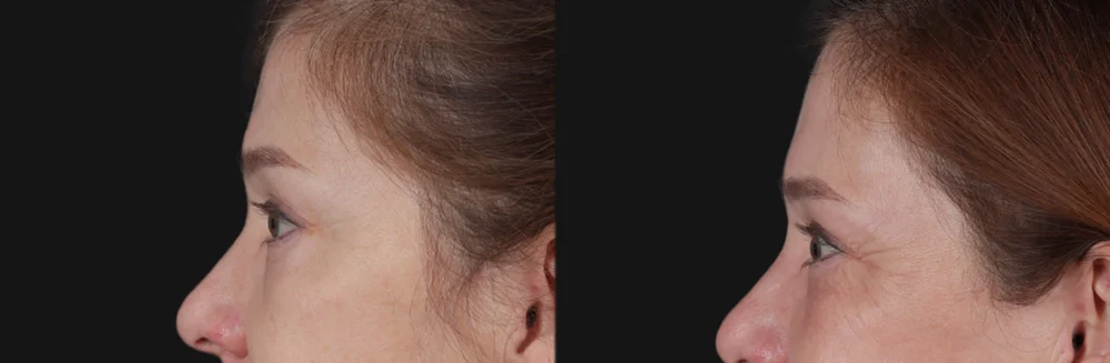 Blepharoplasty case #266684