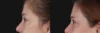 Blepharoplasty case #266684 slider thumbnail