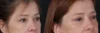 Blepharoplasty case #266684 slider thumbnail