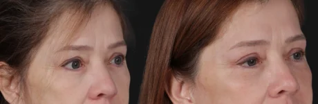 Blepharoplasty case #266684