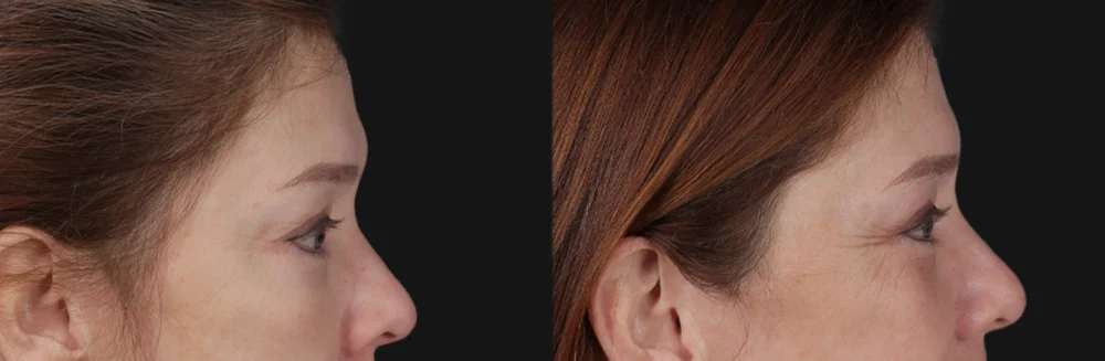 Blepharoplasty case #266684
