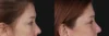 Blepharoplasty case #266684 slider thumbnail
