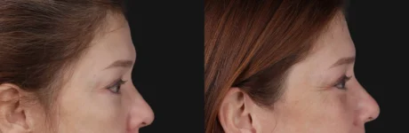 Blepharoplasty case #266684
