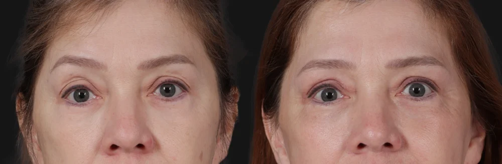 Blepharoplasty case #266684