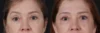 Blepharoplasty case #266684 slider thumbnail