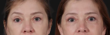 Blepharoplasty case #266684
