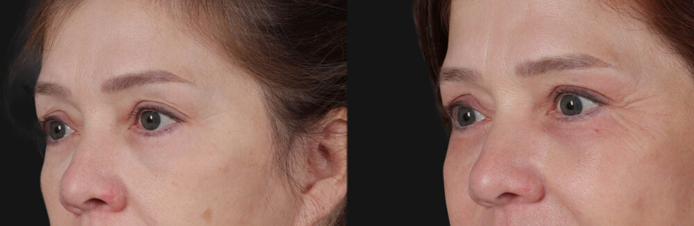 Blepharoplasty case #266684