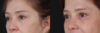 Blepharoplasty case #266684 slider thumbnail