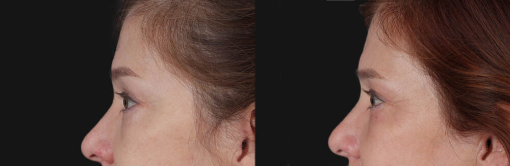 Blepharoplasty case #266684
