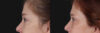 Blepharoplasty case #266684 slider thumbnail