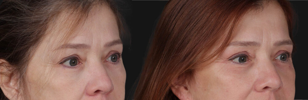 Blepharoplasty case #266684