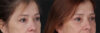Blepharoplasty case #266684 slider thumbnail