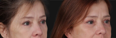 Blepharoplasty case #266684