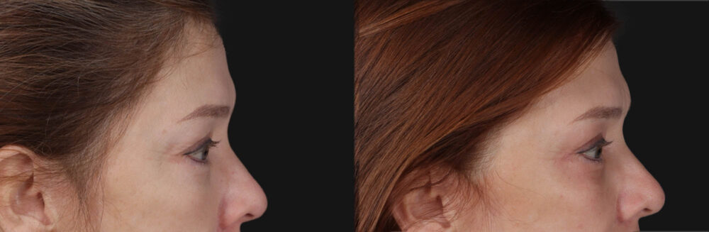 Blepharoplasty case #266684