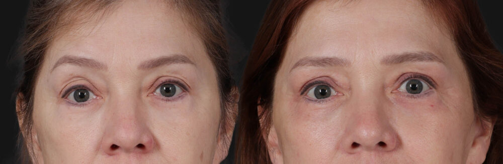 Blepharoplasty case #266684