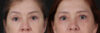 Blepharoplasty case #266684 slider thumbnail