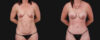 Mommy Makeover case #266677 slider thumbnail