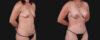Mommy Makeover case #266677 slider thumbnail