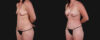 Mommy Makeover case #266677 slider thumbnail