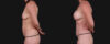 Mommy Makeover case #266677 slider thumbnail