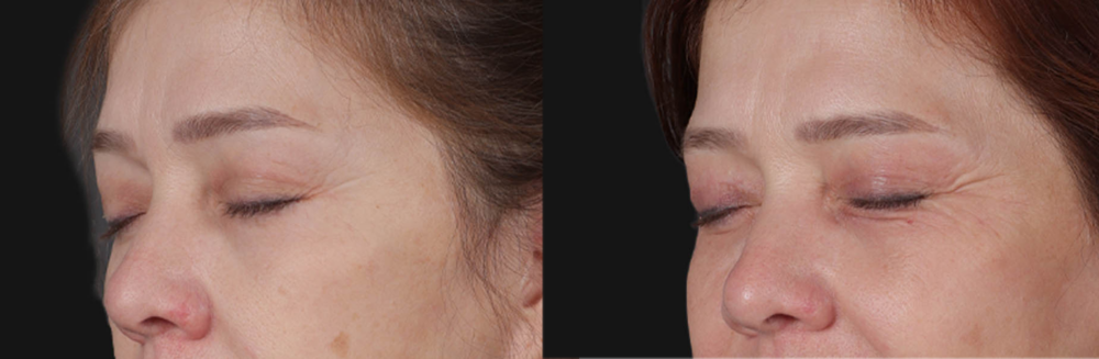 Blepharoplasty case #266684