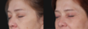 Blepharoplasty case #266684 slider thumbnail