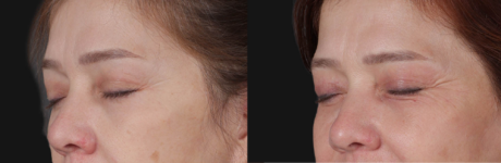 Blepharoplasty case #266684
