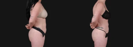 Liposuction case #266707