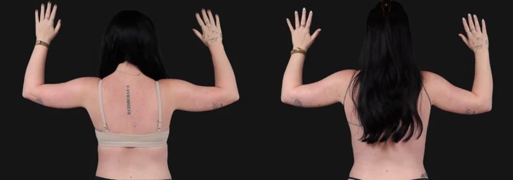 Liposuction case #266707