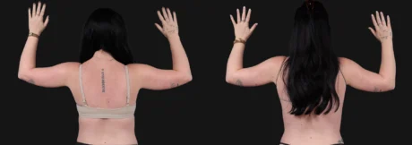 Liposuction case #266707