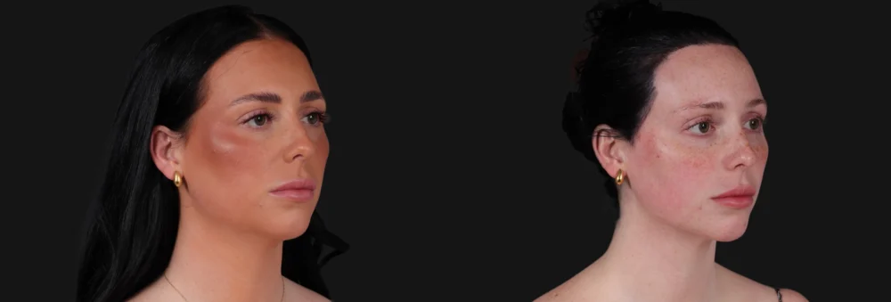 Submental Liposuction case #266701
