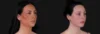 Submental Liposuction case #266701 slider thumbnail