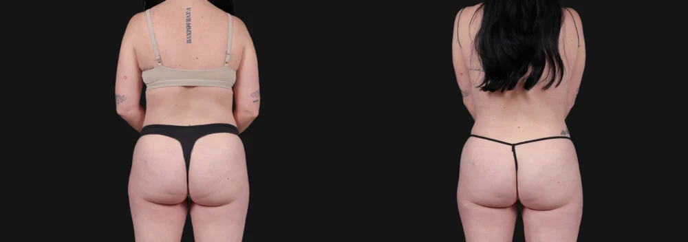 Liposuction case #266707