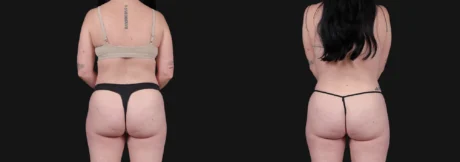 Liposuction case #266707