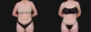 Liposuction case #266707 slider thumbnail