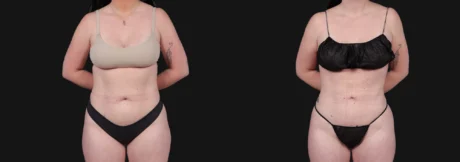 Liposuction case #266707